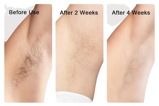 جهاز Femz Pro لإزالة الشعر بتقنية IPL