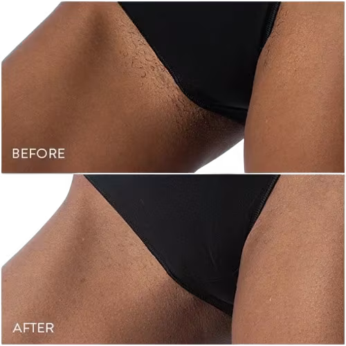 جهاز Femz Pro لإزالة الشعر بتقنية IPL