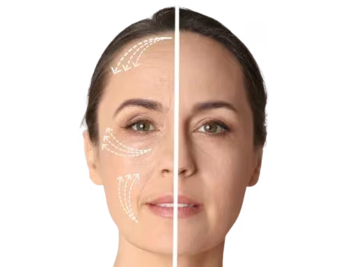 جهاز Femz Pro لإزالة الشعر بتقنية IPL